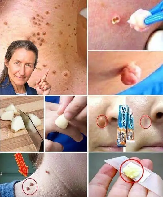 Le verruche plantari e le escrescenze cutanee spariranno naturalmente con questo trucco